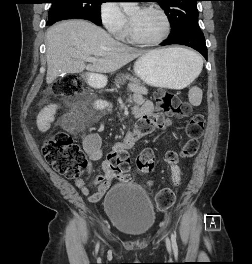 File:Closed loop obstruction - internal hernia into nephrectomy bed (Radiopaedia 59867-67320 B 52).jpg