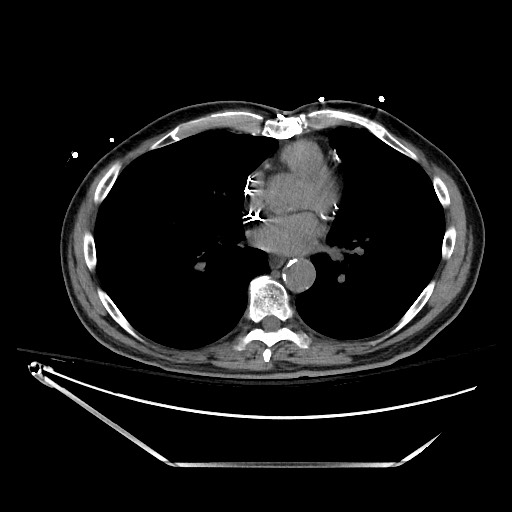 File:Closed loop obstruction due to adhesive band, resulting in small bowel ischemia and resection (Radiopaedia 83835-99023 Axial non-contrast 1).jpg