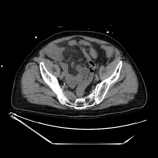 File:Closed loop obstruction due to adhesive band, resulting in small bowel ischemia and resection (Radiopaedia 83835-99023 Axial non-contrast 125).jpg