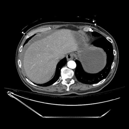 File:Closed loop obstruction due to adhesive band, resulting in small bowel ischemia and resection (Radiopaedia 83835-99023 B 26).jpg