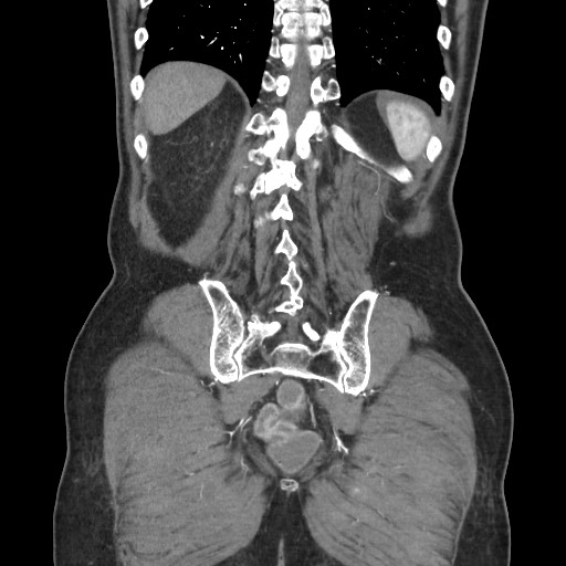 File:Closed loop obstruction due to adhesive band, resulting in small bowel ischemia and resection (Radiopaedia 83835-99023 C 101).jpg