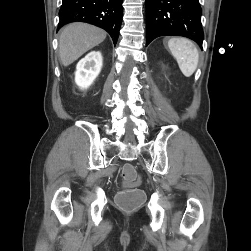 Closed loop obstruction due to adhesive band, resulting in small bowel ischemia and resection (Radiopaedia 83835-99023 C 94).jpg