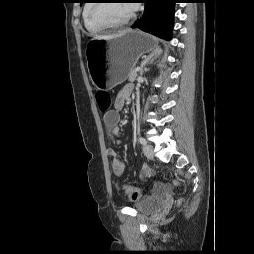 Closed loop small bowel obstruction (Radiopaedia 65403-74451 C 63).jpg