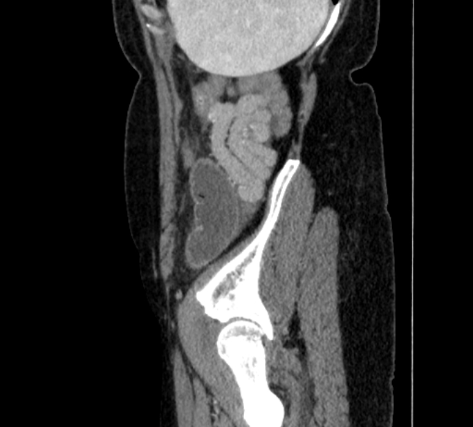 Closed loop small bowel obstruction (Radiopaedia 71211-81508 C 147).jpg