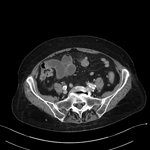 Closed loop small bowel obstruction - adhesions (Radiopaedia 59269-66611 A 92).jpg