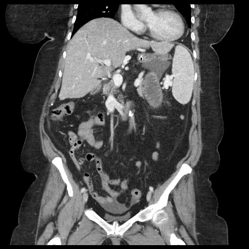 Closed loop small bowel obstruction - internal hernia (Radiopaedia 65402-74450 B 52).jpg