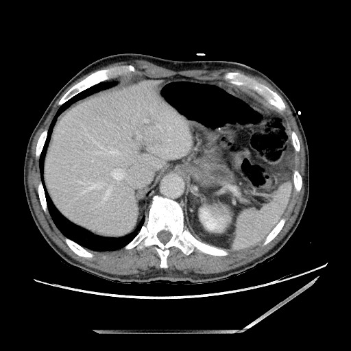 Closed loop small bowel obstruction - omental adhesion causing "internal hernia" (Radiopaedia 85129-100682 A 27).jpg