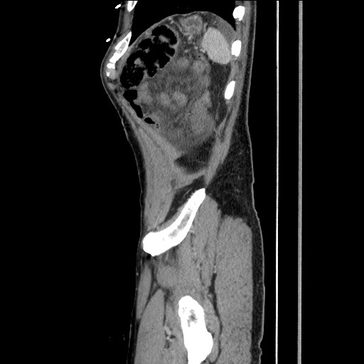 Closed loop small bowel obstruction - omental adhesion causing "internal hernia" (Radiopaedia 85129-100682 C 154).jpg