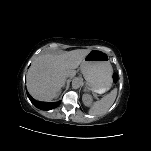 File:Closed loop small bowel obstruction due to adhesive band, with intramural hemorrhage and ischemia (Radiopaedia 83831-99017 Axial non-contrast 41).jpg