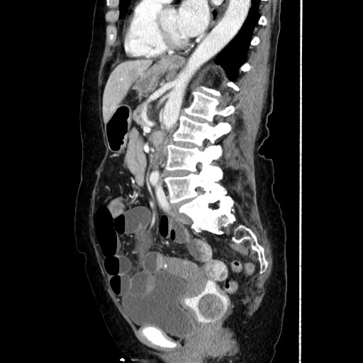 Closed loop small bowel obstruction due to adhesive band, with intramural hemorrhage and ischemia (Radiopaedia 83831-99017 D 112).jpg