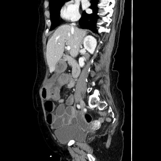 Closed loop small bowel obstruction due to adhesive band, with intramural hemorrhage and ischemia (Radiopaedia 83831-99017 D 87).jpg