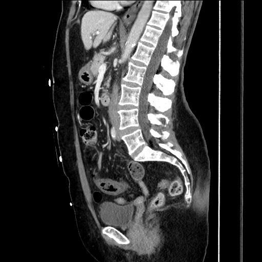 Closed loop small bowel obstruction due to adhesive bands - early and late images (Radiopaedia 83830-99014 C 92).jpg
