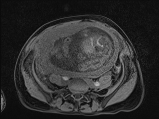 Closed loop small bowel obstruction in pregnancy (MRI) (Radiopaedia 87637-104031 F 28).jpg