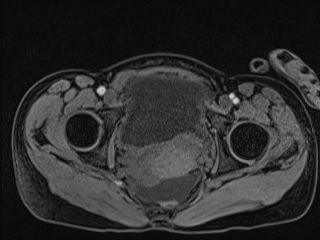 File:Closed loop small bowel obstruction in pregnancy (MRI) (Radiopaedia 87637-104031 G 18).jpg