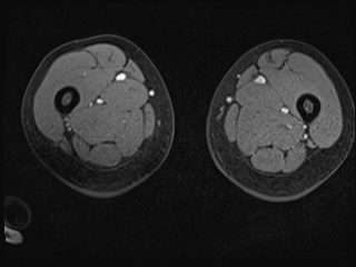 Closed loop small bowel obstruction in pregnancy (MRI) (Radiopaedia 87637-104031 G 68).jpg