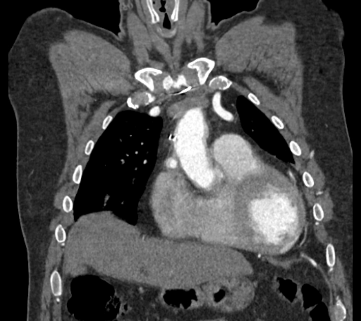 Coarctation of the aorta (Radiopaedia 53752-59822 B 23).jpg