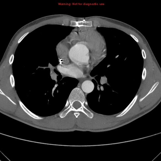 File:Coarctation of the aorta (Radiopaedia 9434-10118 A 96).jpg