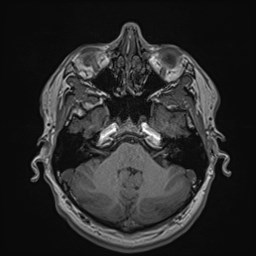 File:Cochlear incomplete partition type III associated with hypothalamic hamartoma (Radiopaedia 88756-105498 Axial T1 59).jpg