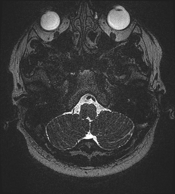 Cochlear incomplete partition type III associated with hypothalamic hamartoma (Radiopaedia 88756-105498 Axial T2 35).jpg