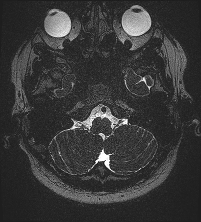 Cochlear incomplete partition type III associated with hypothalamic hamartoma (Radiopaedia 88756-105498 Axial T2 46).jpg