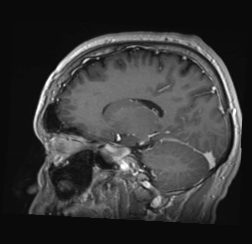 File:Cochlear incomplete partition type III associated with hypothalamic hamartoma (Radiopaedia 88756-105498 Sagittal T1 C+ 33).jpg
