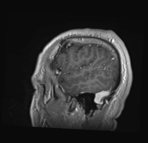 Cochlear incomplete partition type III associated with hypothalamic hamartoma (Radiopaedia 88756-105498 Sagittal T1 C+ 46).jpg