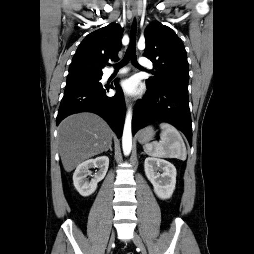 File:Codominant double aortic arch (Radiopaedia 56012-62637 B 28).jpg