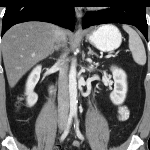 File:Collateral circulation following left renal vein thrombosis (Radiopaedia 17319-17013 renal cortical phase 14).jpg