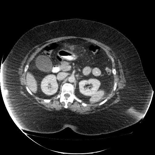 File:Collection due to leak after sleeve gastrectomy (Radiopaedia 55504-61972 A 32).jpg
