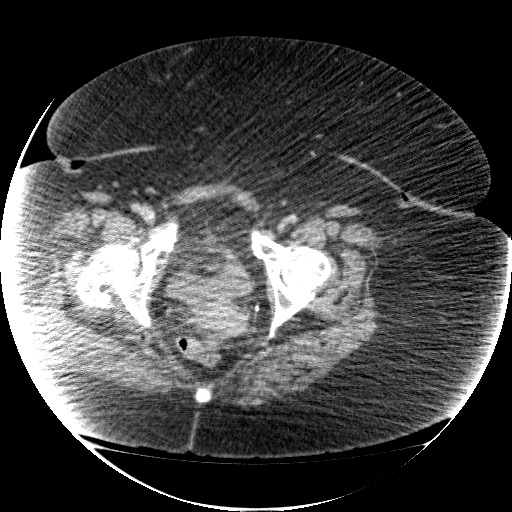 File:Collection due to leak after sleeve gastrectomy (Radiopaedia 55504-61972 A 77).jpg