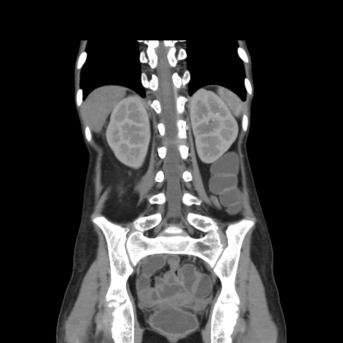 File:Colocolic fistula - Crohn disease (Radiopaedia 57063-63955 B 33).jpg