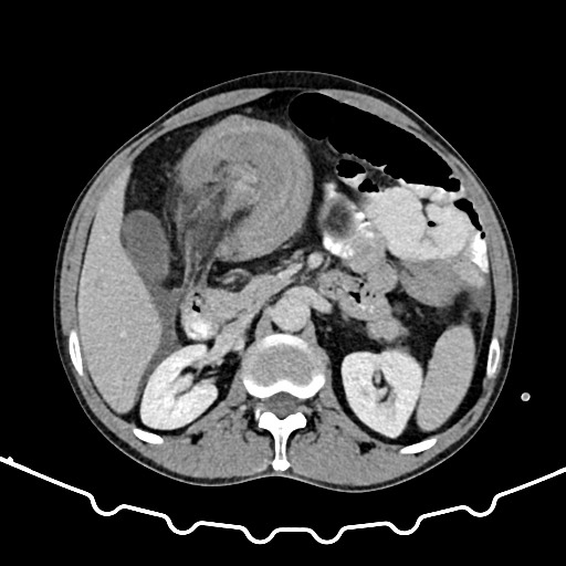 Colocolic intussusception due to large lipoma (Radiopaedia 68773-78482 A 63).jpg
