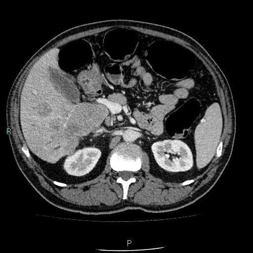 Colon adenocarcinoma with calcific liver metastasis (Radiopaedia 55745-62300 B 14).jpg