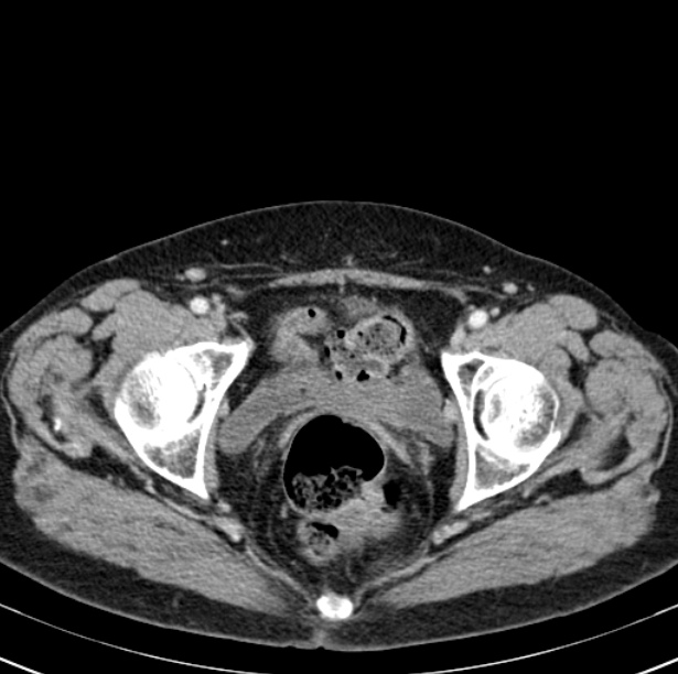 Colon carcinoma with hepatic metastases (Radiopaedia 29477-29961 A 107).jpg