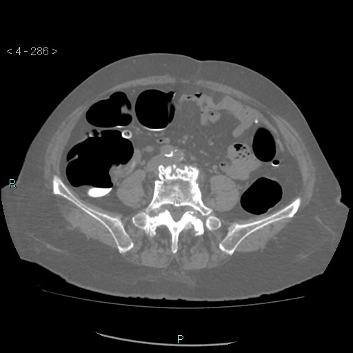 File:Colonic lipomas (Radiopaedia 49137-54244 Axial bone window 128).jpg