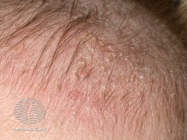 File:Cradle cap (DermNet NZ dermatitis-cradlecap2).jpg