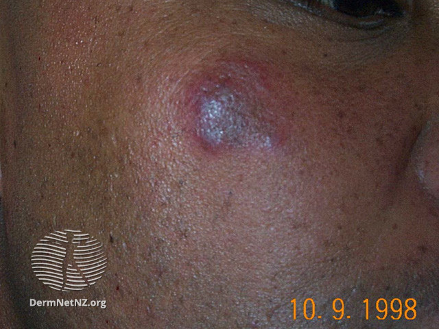 Cutaneous lupus erythematosus (DermNet NZ immune-lupus-erythematosus-2550).jpg