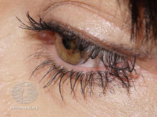 File:Effect of bimatoprost solution on eyelashes (DermNet NZ treatments-bimatoprost03).jpg