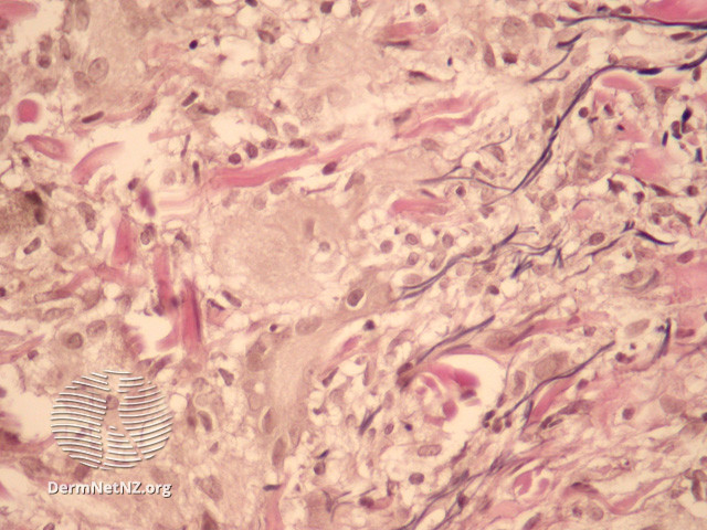 File:Figure 3 (DermNet NZ pathology-e-annular-elastolytic-granuloma-figure-3).jpg