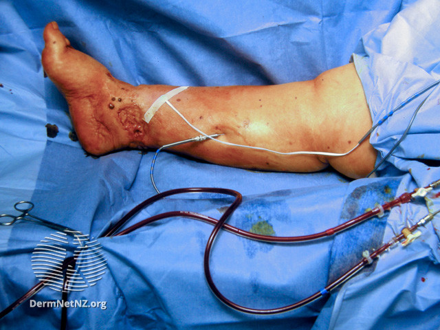 File:Isolated limb perfusion (DermNet NZ procedures-limb-perfusion).jpg