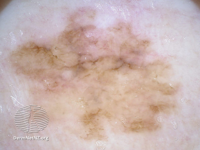 File:Melanoma in situ, nonpolarised dermoscopy view (DermNet NZ 163708).jpg