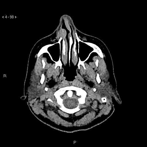 Nasolabial cyst (Radiopaedia 75125-86194 Axial non-contrast 60).jpg