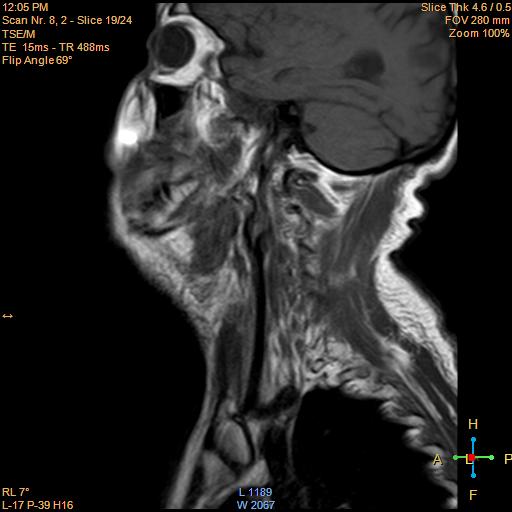 File:Nasopharyngeal carcinoma (Radiopaedia 22375-22403 Sagittal T1 14).jpg