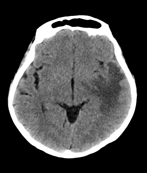 File:Nasopharyngeal carcinoma with cerebral abscess (Radiopaedia 43018-46275 Axial non-contrast 25).png