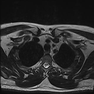 Nasopharyngeal carcinoma with perineural spread (Radiopaedia 55030-61380 Axial T2 89).jpg