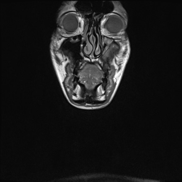 Nasopharyngeal carcinoma with skull base invasion (Radiopaedia 53415-59485 Coronal T1 38).jpg