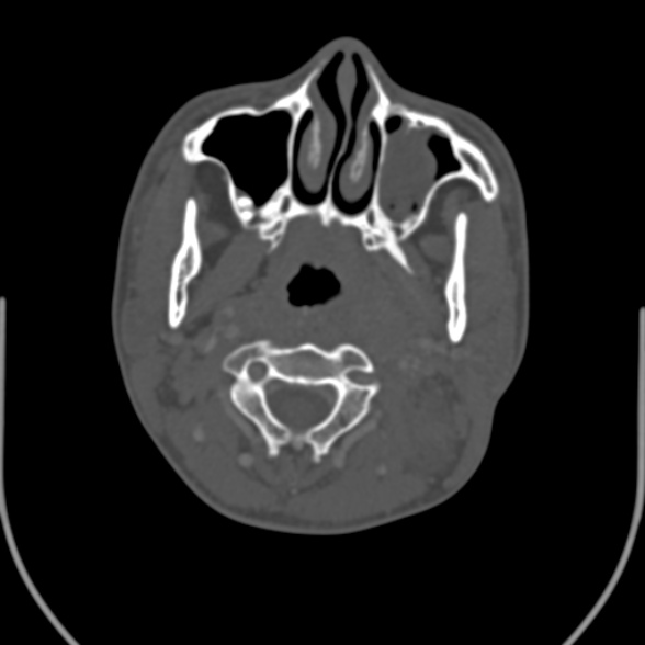 Nasopharyngeal carcinoma with skull base invasion (Radiopaedia 53415-59705 Axial bone window 67).jpg