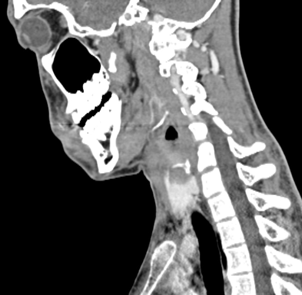 Nasopharyngeal carcinoma with skull base invasion (Radiopaedia 53415-59705 C 26).jpg