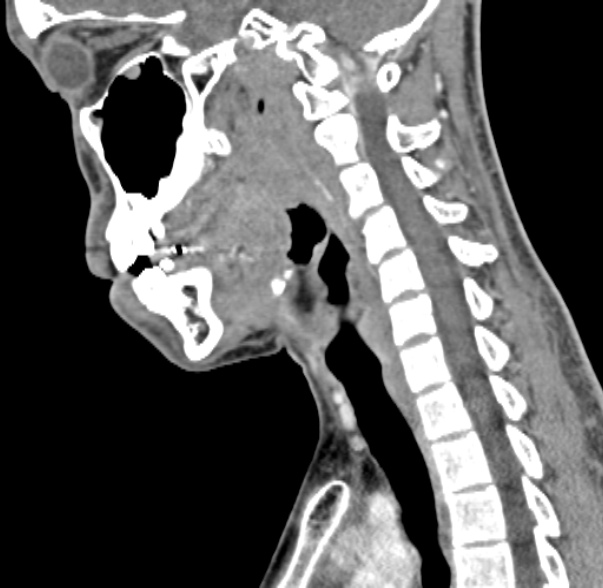 Nasopharyngeal carcinoma with skull base invasion (Radiopaedia 53415-59705 C 30).jpg