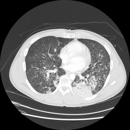 Near-drowning pulmonary edema (Radiopaedia 59457-66814 Axial lung window 35).jpg